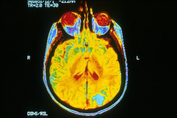 Учёные научились бороться с неизлечимым раком мозга