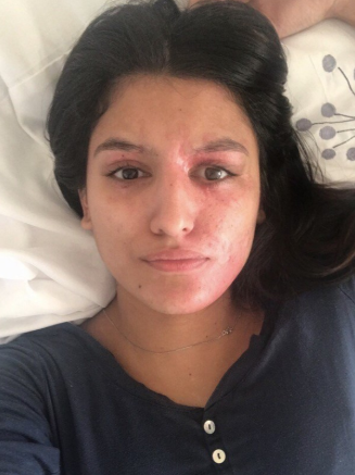 Жертва кислотной атаки продемонстрировала лицо без макияжа