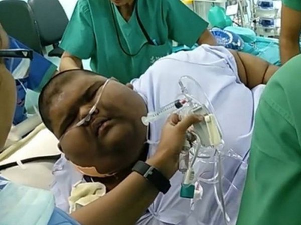Самый толстый ребенок в мире сбросил 65 килограммов