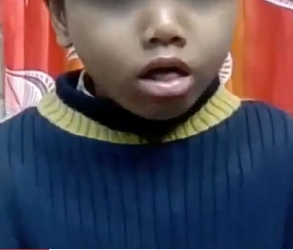 В Индии ребенок начал издавать странные звуки из-за проглоченной пищалки