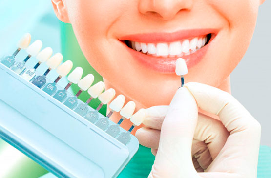Керамические виниры: идеальная улыбка без повторных посещений стоматолога